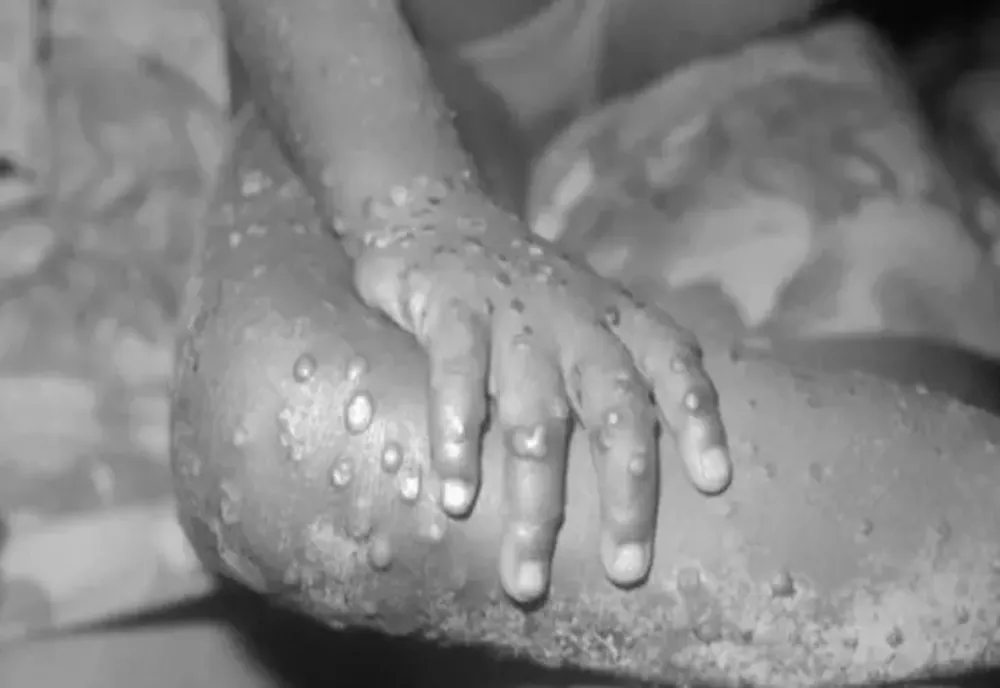 Pacientul din Timiş diagnosticat cu variola maimuţei, în izolare la domiciliu. Care este starea sa de sănătate