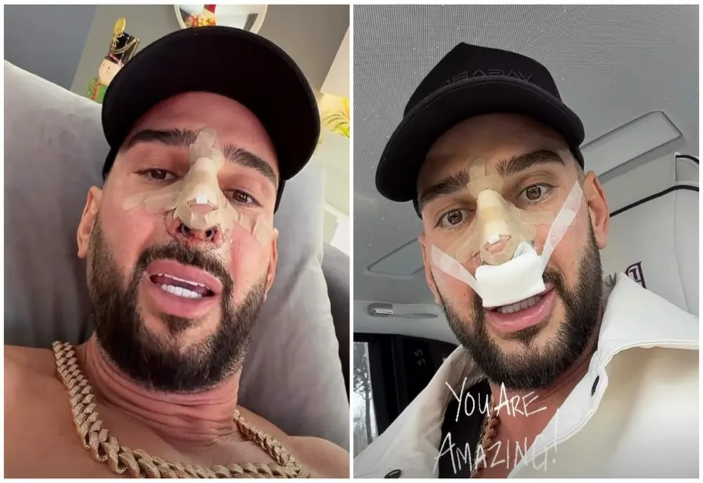 Cum arată nasul lui Dorian Popa după operație. Influencerul și-a dat bandajele jos